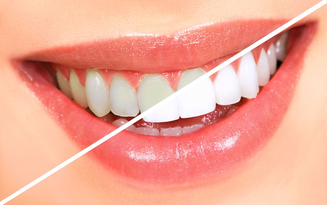 Tẩy trắng răng duy trì được bao nhiêu lâu?