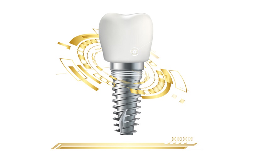 Trồng Răng Implant Cho Người Cao Tuổi – Lấy Lại Tự Tin & Sức Khỏe Ăn Nhai