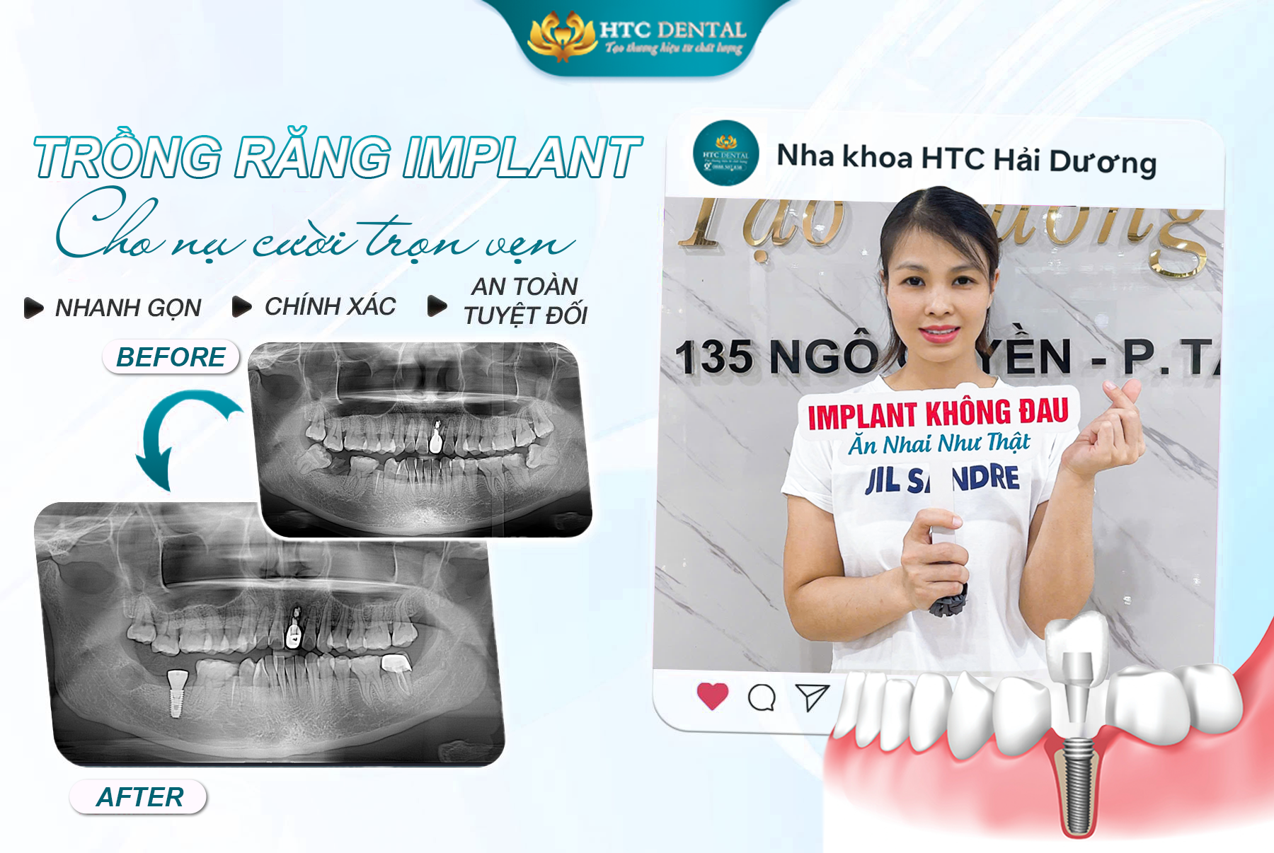 TRỒNG RĂNG IMPLANT - CHO NỤ CƯỜI TRỌN VẸN