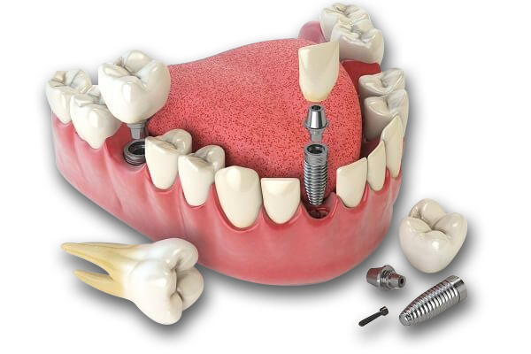 TRỒNG RĂNG IMPLANT CÓ ĐAU KHÔNG? CHUYÊN GIA NHA KHOA HTC HẢI DƯƠNG GIẢI ĐÁP CHI TIẾT