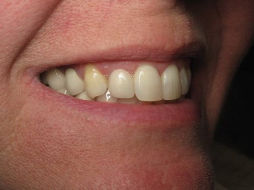 Trồng răng Implant nên chọn loại trụ nào?