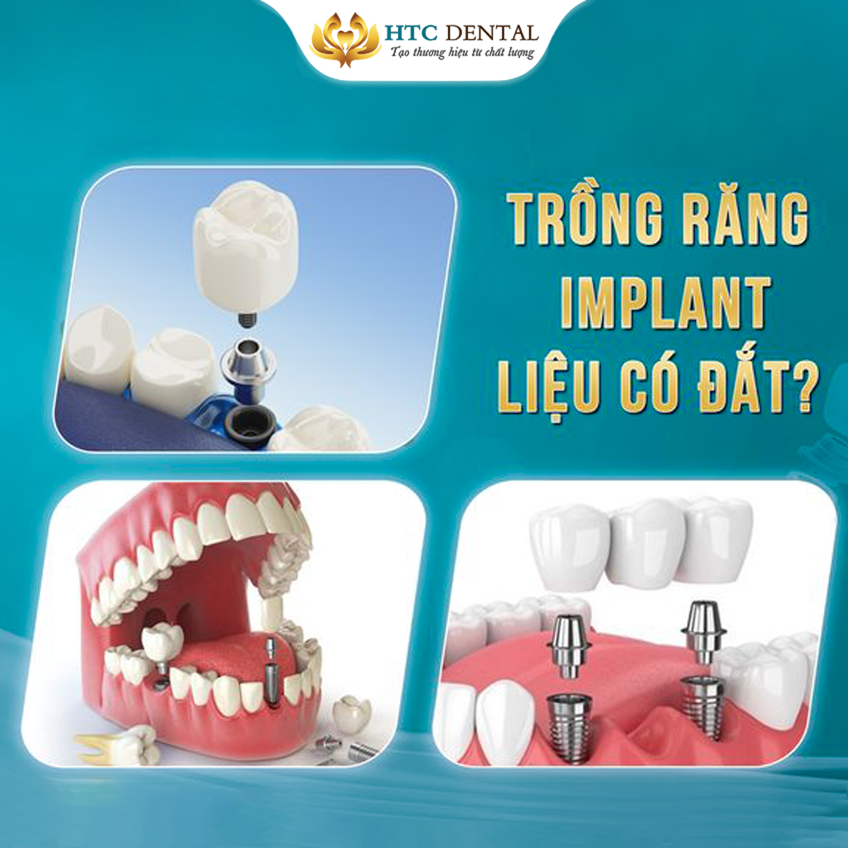 Trồng Răng Implant Tại Sao Đắt Vậy? 5 Lý Do Khiến Giá Implant Luôn Cao
