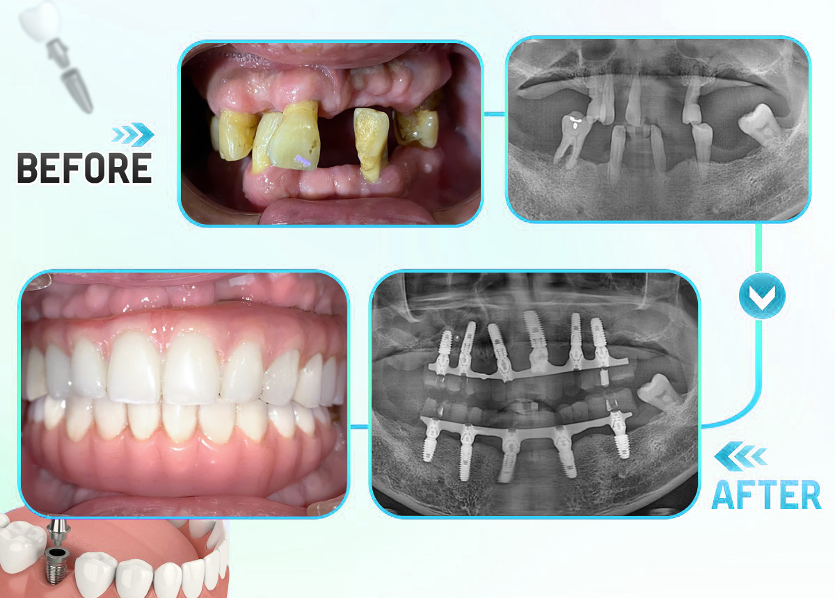 Trồng răng Implant toàn hàm All-on-4, All-on-6 tại Hải Dương – Giải pháp phục hồi răng mất toàn diện