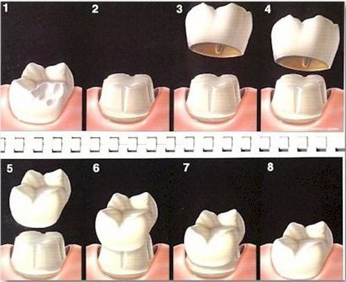 Trồng răng sứ kim loại sử dụng được bao lâu?