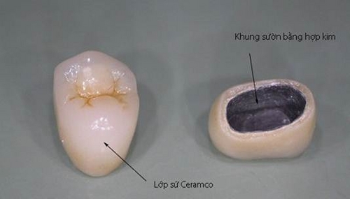 Cấu tạo của răng sứ kim loại