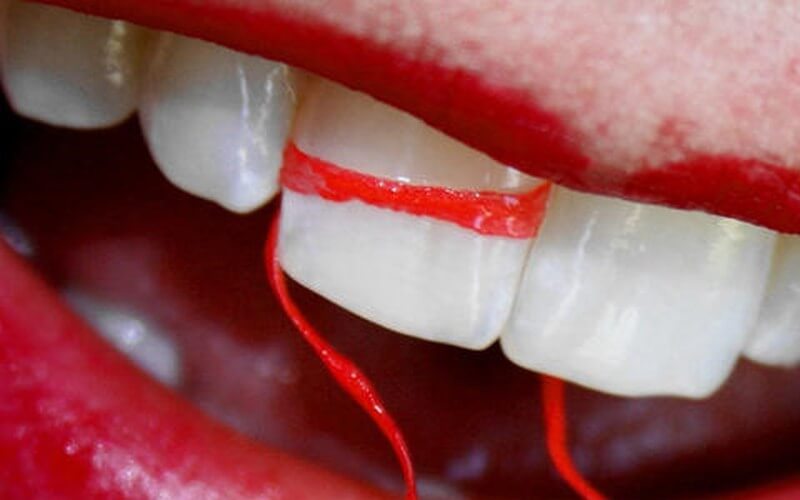 Những phương pháp tự điều trị răng thưa ở nhà có hiệu quả và an toàn?