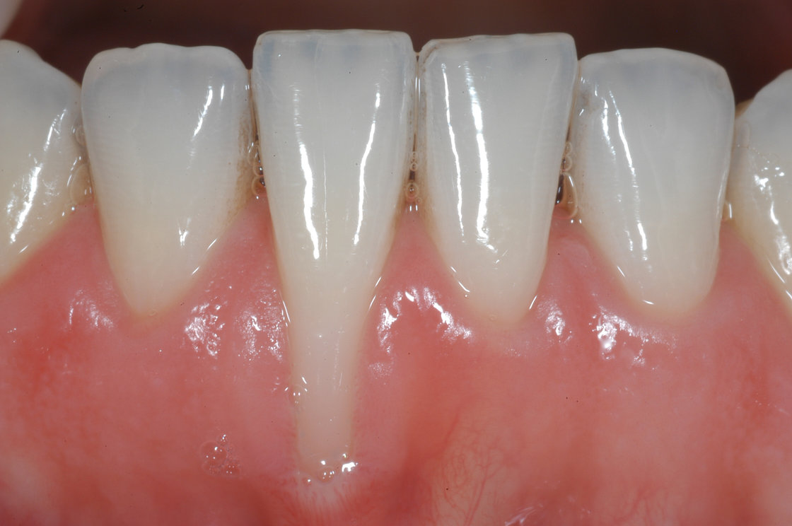 Tụt lợi chân răng là gì? Nguyên nhân và cách điều trị