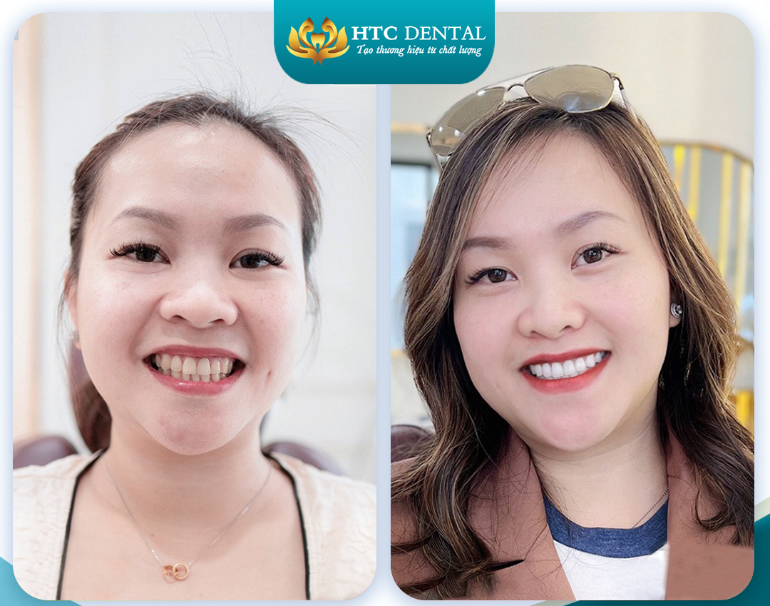 Việt kiều về Việt Nam làm răng – Vì sao nên chọn Nha khoa HTC