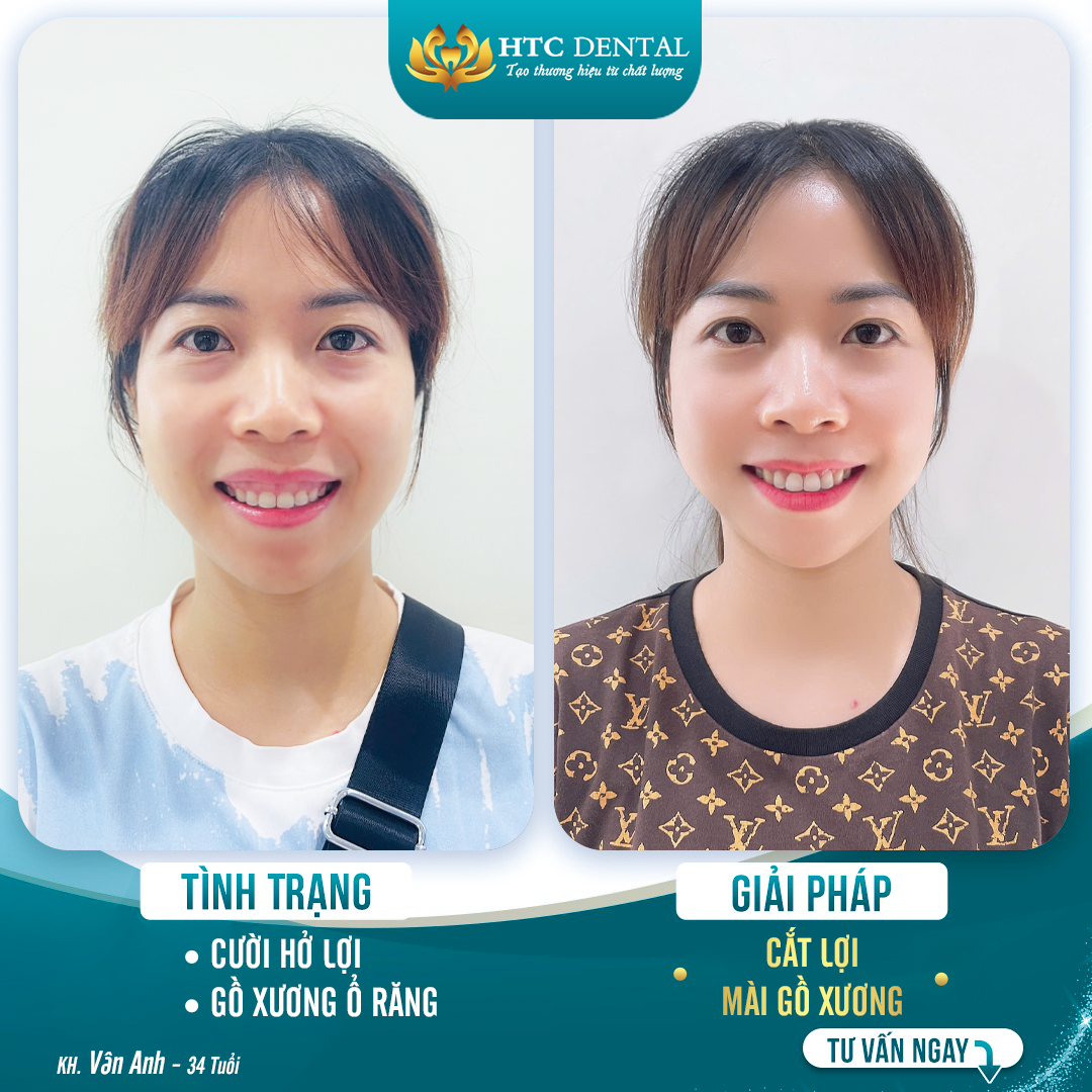 잇몸 미소 교정 – HTC 치과의 안전하고 효과적인 거미 스마일 치료