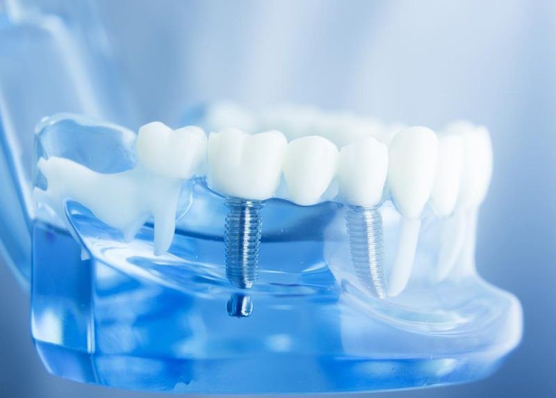 Vị trí cấy ghép cũng sẽ ảnh hưởng đến việc trồng răng implant có đau không